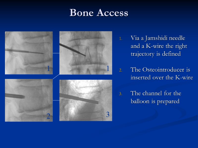 Bone Access Via a Jamshidi needle and a K-wire the right trajectory is defined